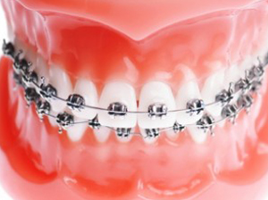 Fixed applications/Fixed braces